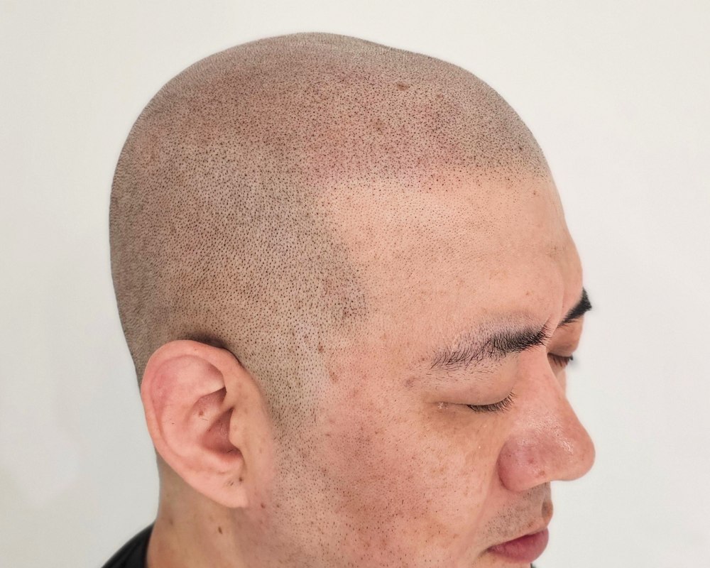 SMP 두피문신