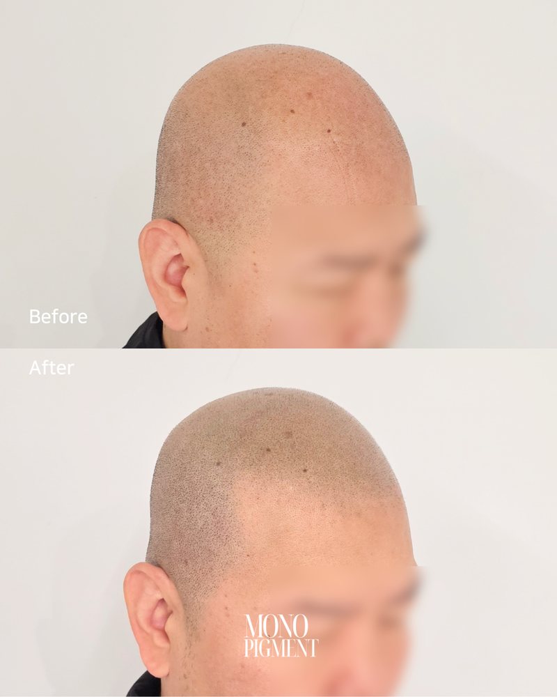SMP 삭발 시술 전후