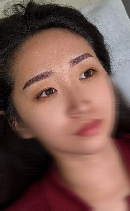 모노피그먼트 시술 장면